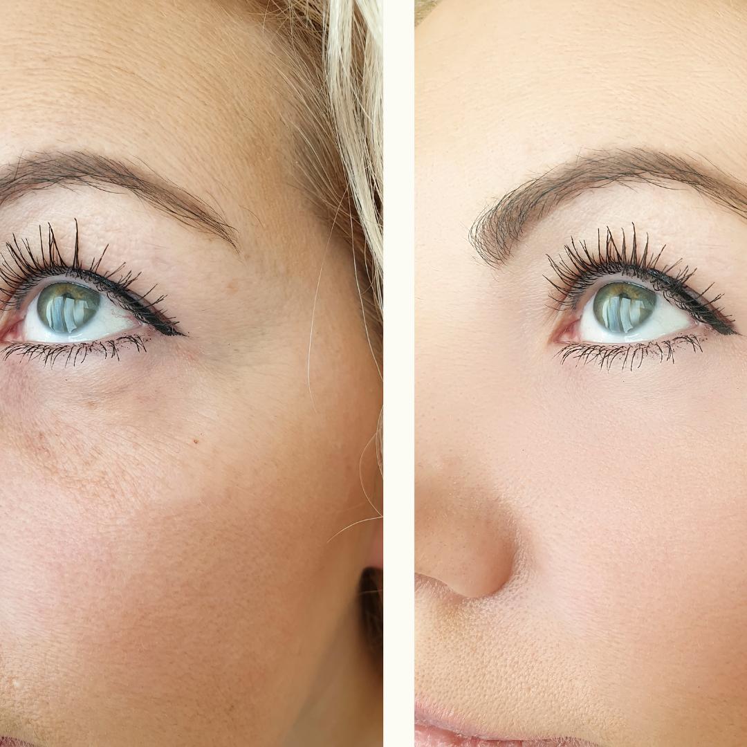 Botox Serum