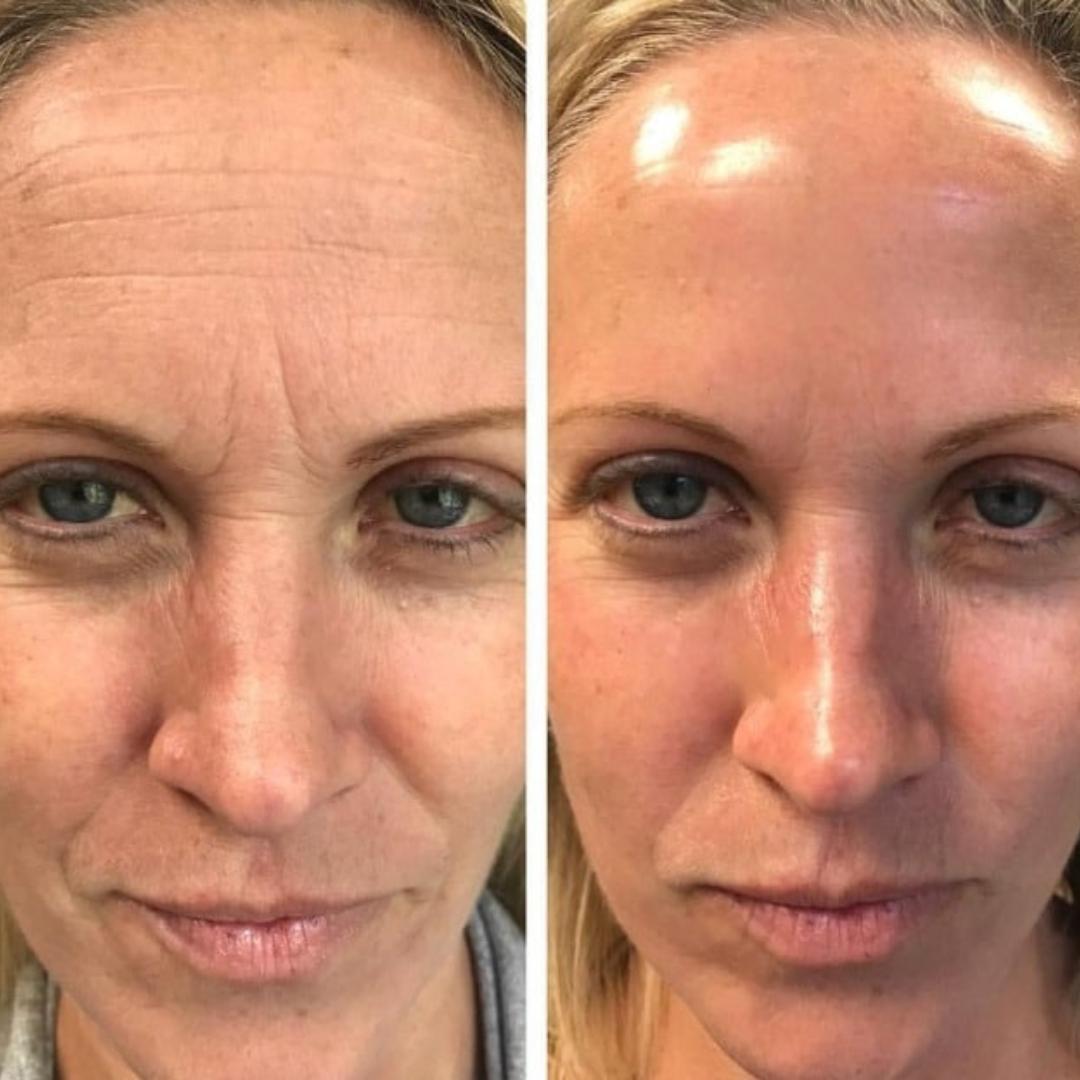 Botox Serum