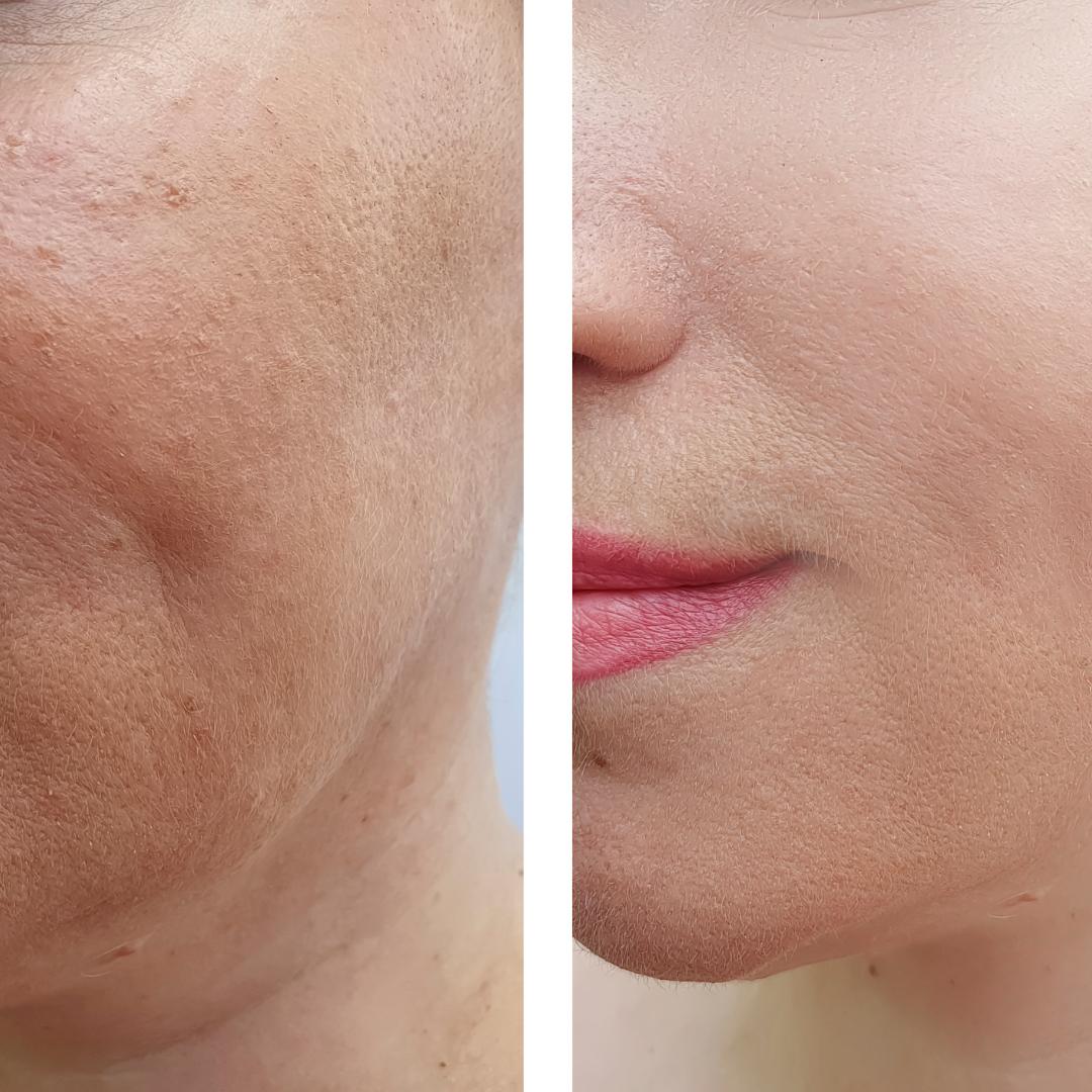 Botox Serum
