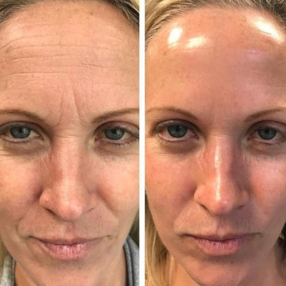 Botox Serum